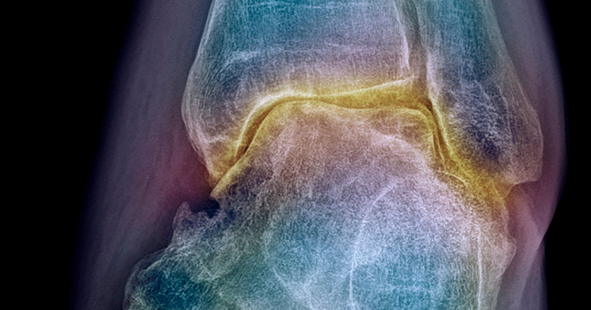 Podcast 42 Diese Therapien wirken bei Arthrose und warum