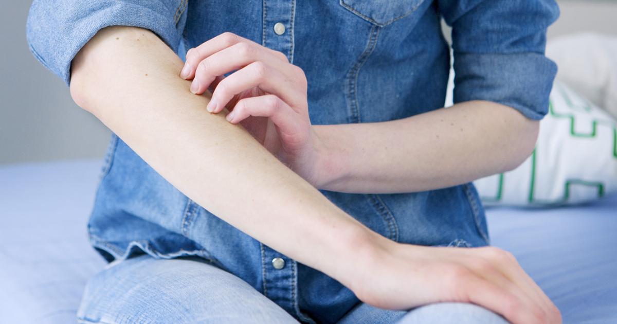 erste Anzeichen von Krätze