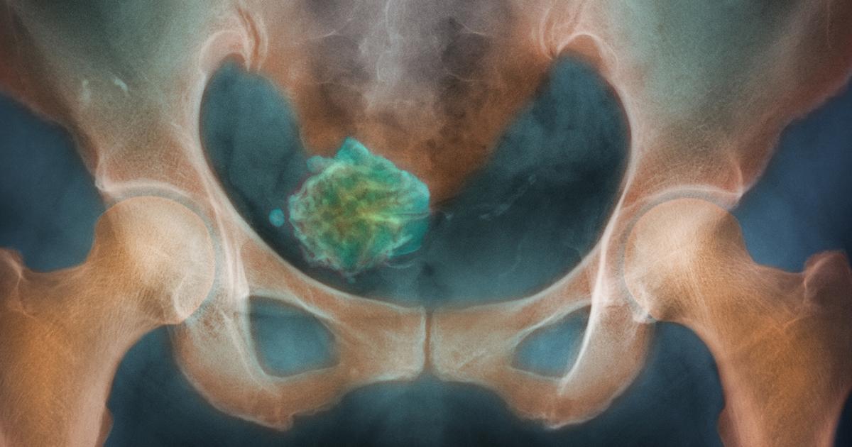 Myome: Symptome und Behandlung
