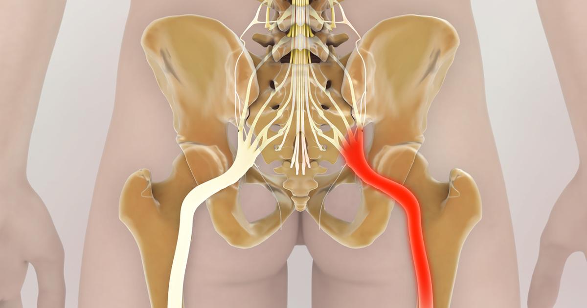 Was IschiasSchmerzen bedeuten, sowie Behandlungen und Übungen, die helfen.