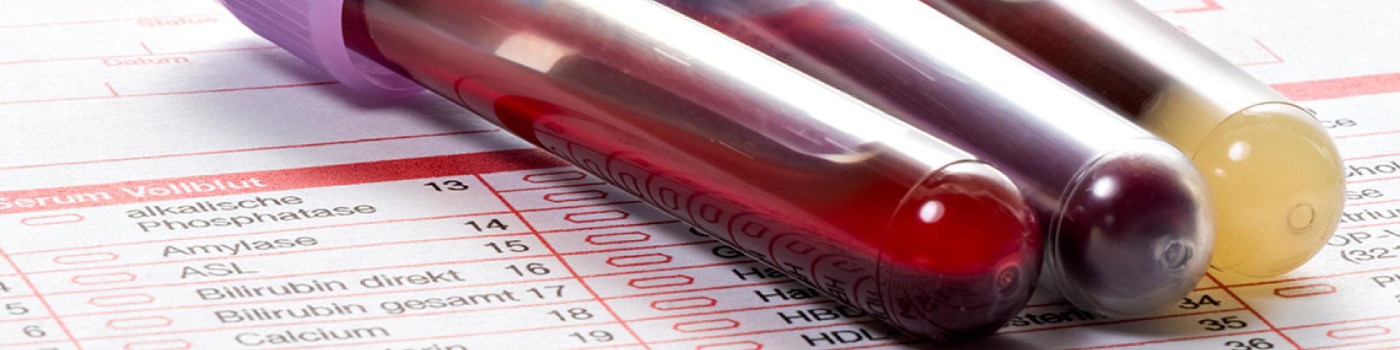 Großes Blutbild: analysiert bestimmte Blutwerte im Labor, hilft bei der Diagnose verschiedener Erkrankungen