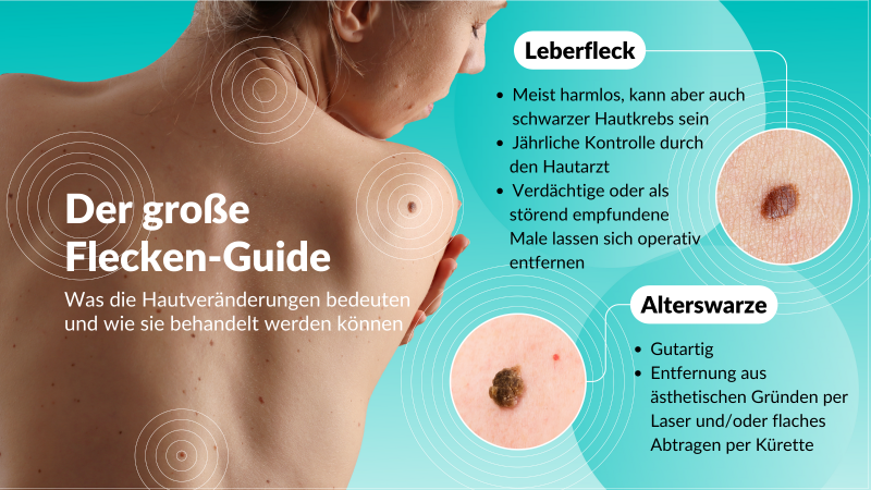 Hautveränderungen: Was Leberflecken und Alterswarzen bedeuten und wie man sie entfernen lassen kann Hautveränderungen: Was Leberflecken und Alterswarzen bedeuten und wie man sie entfernen lassen kann