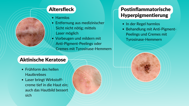 Hautveränderungen: Was Altersflecken, Aktinische Keratose und Postinflammatorische Hyperpigmentierung bedeuten und wie man sie entfernen lassen kann Hautveränderungen: Was Altersflecken, Aktinische Keratose und Postinflammatorische Hyperpigmentierung bedeuten und wie man sie entfernen lassen kann