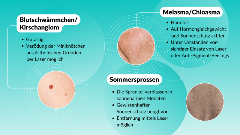 Hautveränderungen: Was Blutschwämmchen (Kirschangiome), Sommersprossen und Melasma (Chloasma) bedeuten und wie man sie entfernen lassen kann Hautveränderungen: Was Blutschwämmchen (Kirschangiome), Sommersprossen und Melasma (Chloasma) bedeuten und wie man sie entfernen lassen kann