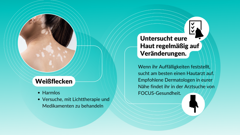 Hautveränderungen: Was Weißflecken bedeuten und wie man sie entfernen lassen kann Hautveränderungen: Was Weißflecken bedeuten und wie man sie entfernen lassen kann