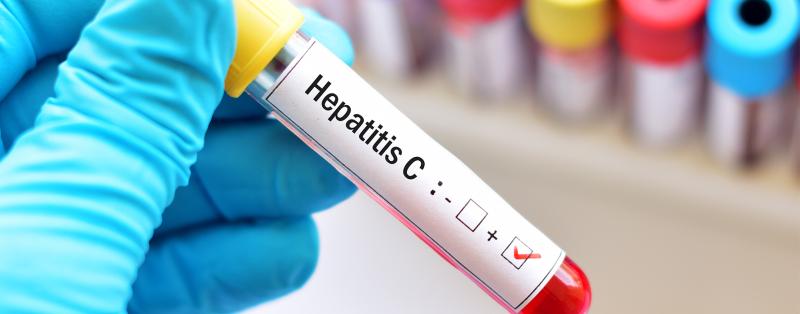 Blutprobe für Hepatitis-C-Virus-Test