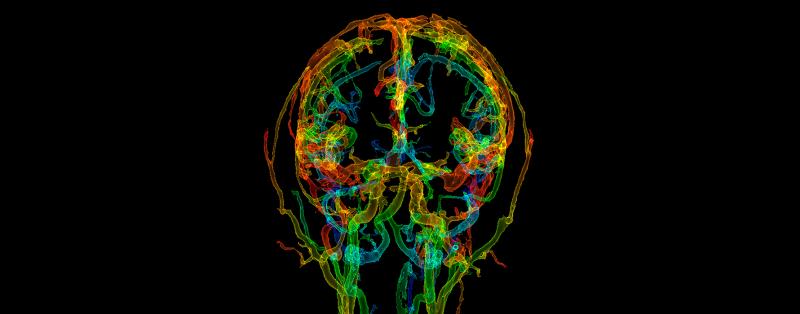 Angiogramm von Blutgefäßen bei einer vaskulären Demenz Vaskuläre Demenz: Angiogramm von Blutgefäßen bei einer vaskulären Demenz