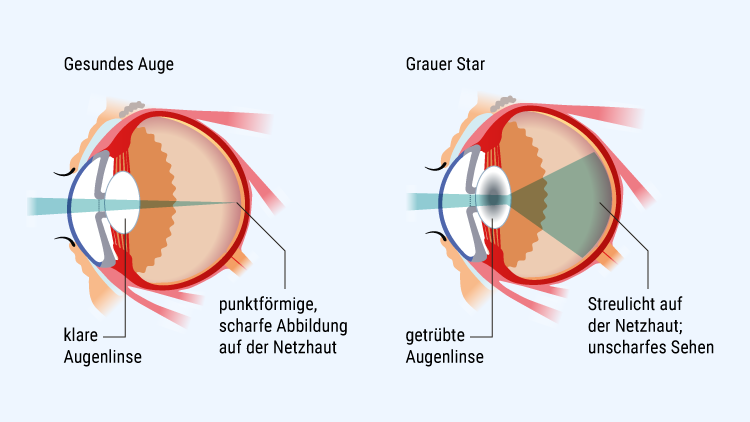 Kunstlinsen Bei Grauem Star Kunstlinsen Bei Grauem Star