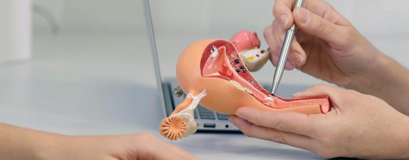 Ausschabung der Gebärmutter: Anatomisches Modell eines Uterus